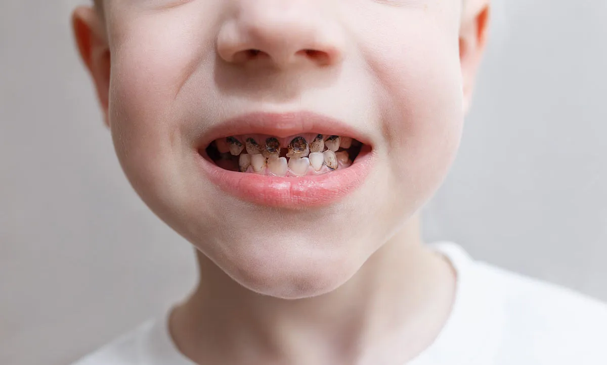 Child with tooth decay